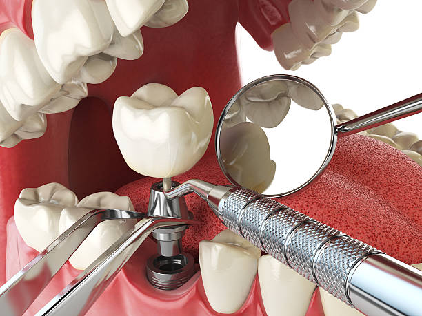 Best Emergency Tooth Extraction in Harlingen, TX